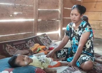 Anak Penderita Hidrosefalus di Cukuh Balak Tanggamus Butuh Bantuan