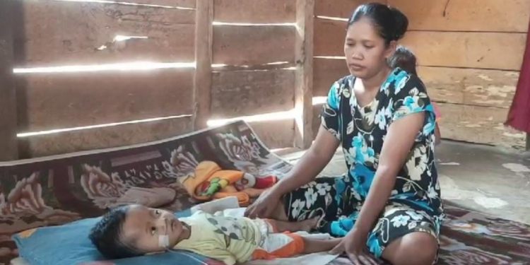 Anak Penderita Hidrosefalus di Cukuh Balak Tanggamus Butuh Bantuan
